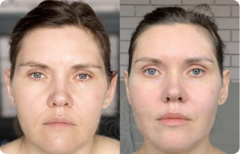 Faceplastica for beginners